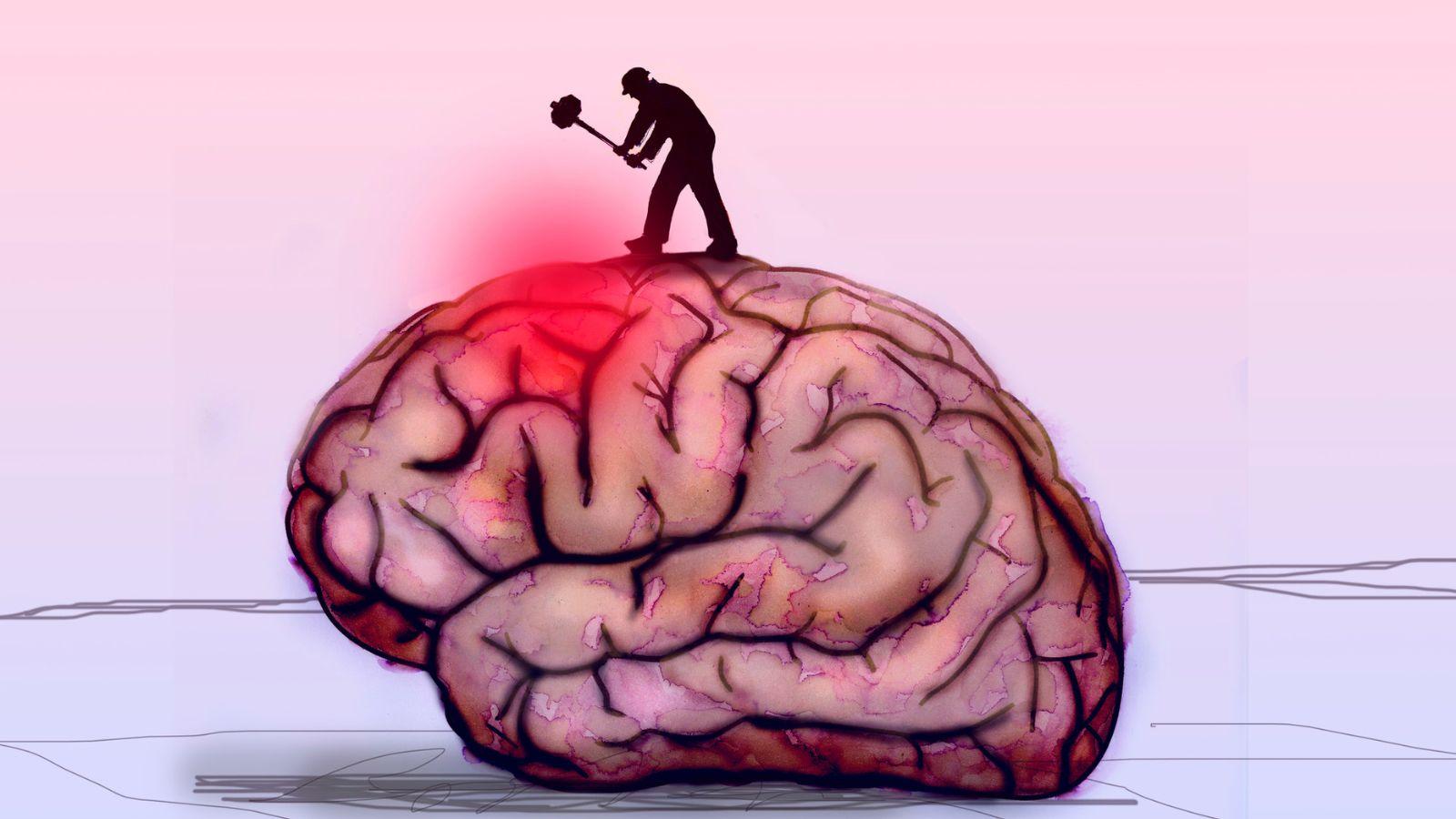 دلایل و درمان سردرد بعد از سکته مغزی