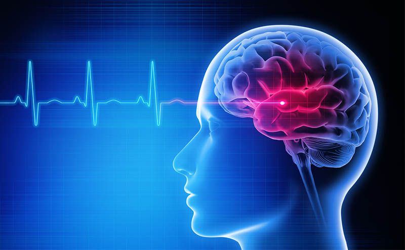 تعریف کلی سکته مغزی