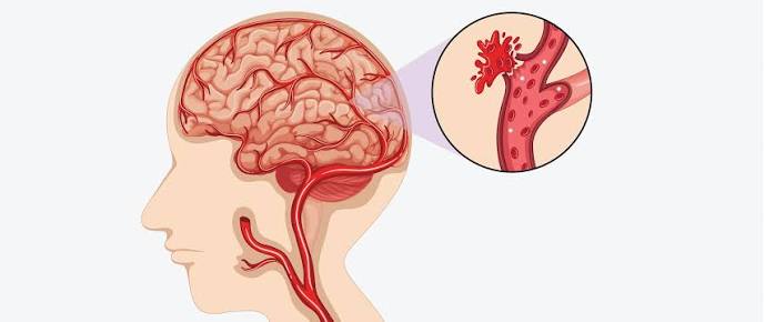 علائم سکته مغزی هموراژیک و ایسکمیک
